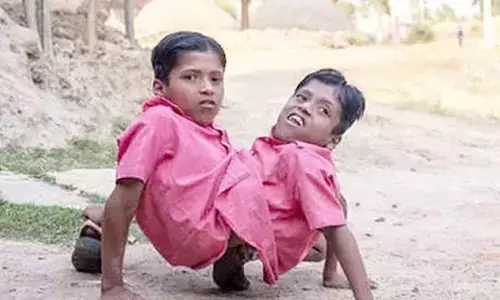 CG-जुड़वा भाइयों की मौत: 4 हाथ व 2 सिर वाले जुड़वां भाई शिवनाथ और शिवराम अब नहीं रहे...कुछ दिनों से थे बीमार...जुड़वा भाइयो पर बन चुकी है कई डाक्यूमेंट्री...