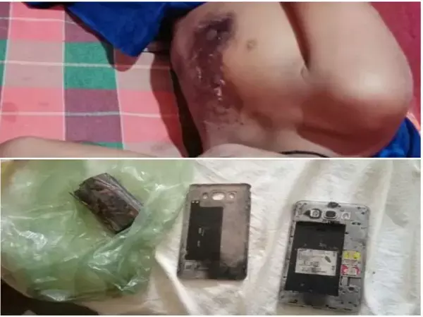 CG-गेम खेलते वक़्त मोबाइल फटा: सात वर्षीय बालक मोबाइल पर खेल रहा था फ़्री फायर गेम, तभी हुआ जोरदार धमाका, बच्चे को कराया गया अस्पताल में भर्ती...
