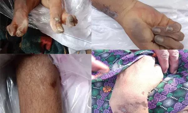 कैदी की हुई मौत,शरीर मे चोट के कई निशान जेल व आबकारी विभाग आमने सामने,न्यायिक जांच हुई शुरू