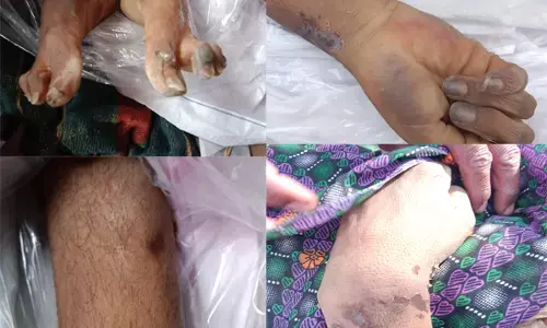 कैदी की हुई मौत,शरीर मे चोट के कई निशान जेल व आबकारी विभाग आमने सामने,न्यायिक जांच हुई शुरू