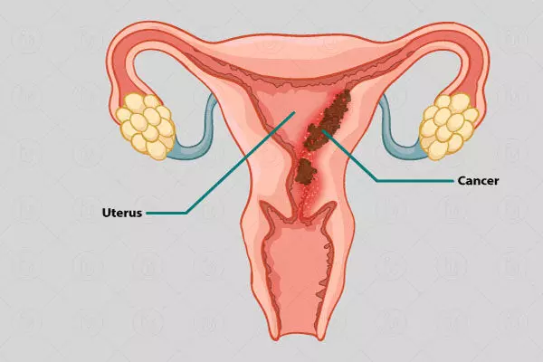 Chemical hair straightener can cause uterine cancer: गर्भाशय कैंसर का कारण बन सकते हैं कैमिकल हेयर स्ट्रेटनर, हो जाइए सावधान Chemical hair straightener can cause uterine cancer: गर्भाशय कैंसर का कारण बन सकते हैं कैमिकल हेयर स्ट्रेटनर, हो जाइए सावधान