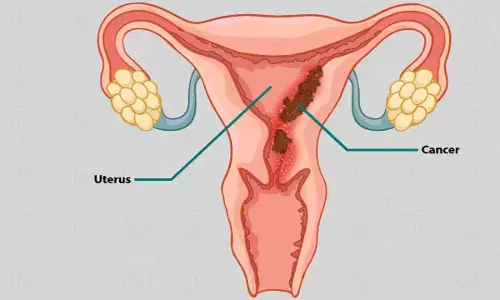 Chemical hair straightener can cause uterine cancer: गर्भाशय कैंसर का कारण बन सकते हैं कैमिकल हेयर स्ट्रेटनर, हो जाइए सावधान