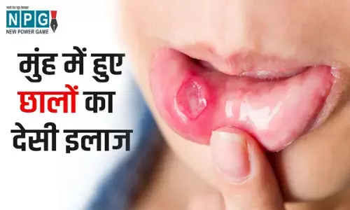 Home remedies for Mouth ulcer: किचन में रखी इन चीज़ों से ठीक करें मुंह के छाले...