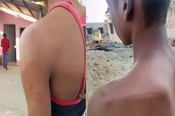 नकल करते पाये जाने पर 2 छात्रों की शिक्षक ने की बेदम पिटाई, घायल छात्र अस्पताल में भर्ती, FIR दर्ज