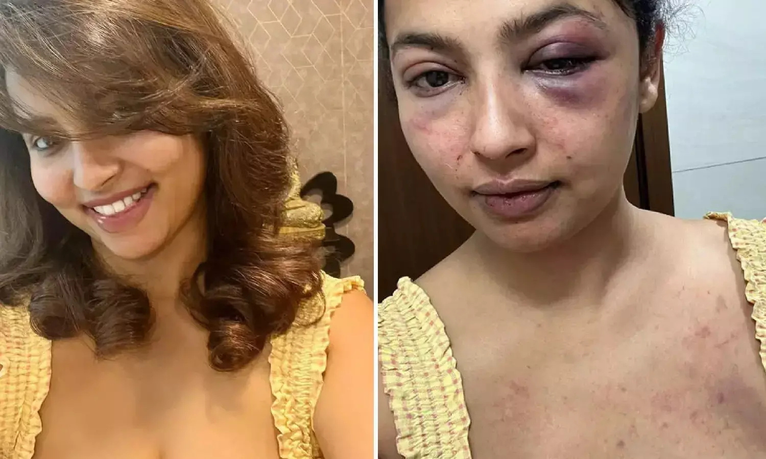 एक्ट्रेस को एक्स बॉयफ्रेंड ने बुरी तरह से पीटा, शेयर की दर्दनाक तस्वीरें, पुलिस ने दर्ज की FIR