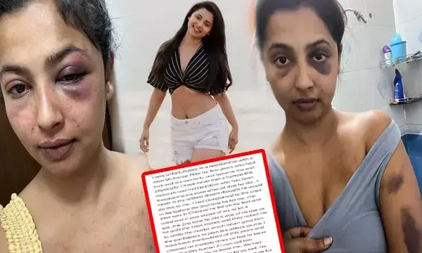 Anika Vikraman-इस खूबसूरत एक्ट्रेस की पिटाई: बॉयफ्रेंड ने मार मारकर सूजा दिया चेहरा, अभिनेत्री ने तस्वीर शेयर कर सुनाई आपबीती...