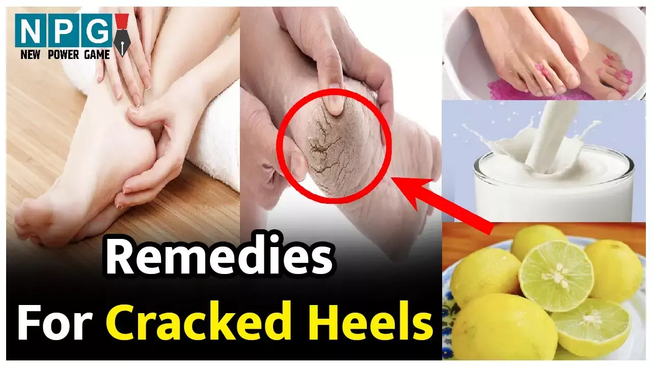 Heal Cracked Heels Naturally: Remedies & Supplements for Skin Health-hkpdtq2012.edu.vn