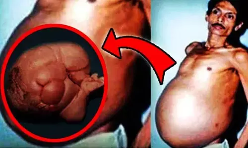 Pregnant Man: 36 साल तक प्रेग्नेंट रहा ये आदमी! फूला पेट देख समझता रहा ट्यूमर, मगर निकल गए जुड़वा बच्चे...