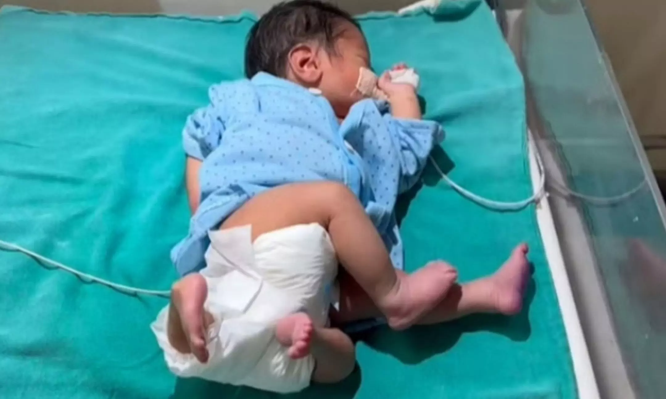 Muzaffarnagar News: मुजफ्फरनगर में चार हाथ-पैर वाले बच्चे ने लिया जन्म, डॉक्टरों ने इलाज शुरू किया
