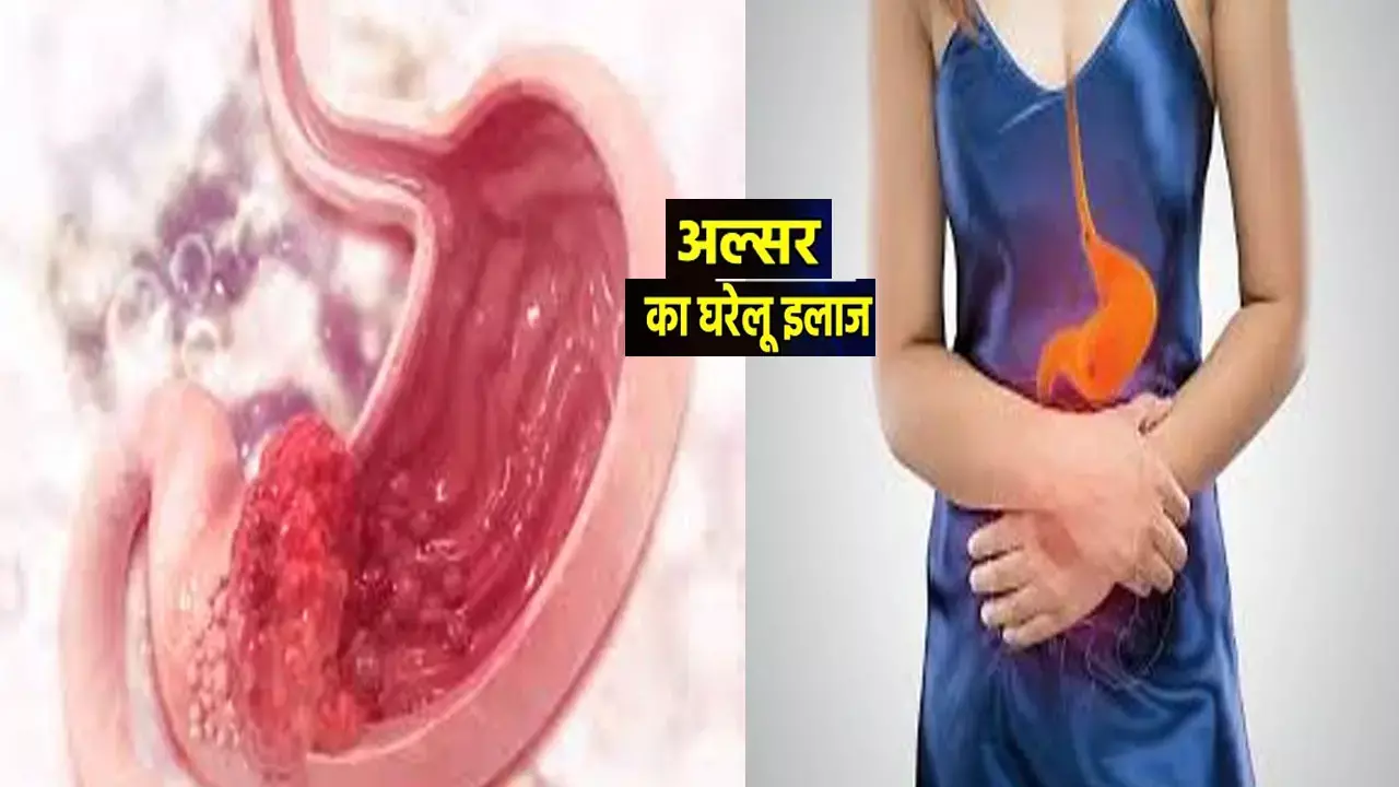 अल्सर को जड़ से खत्म करने के उपाय