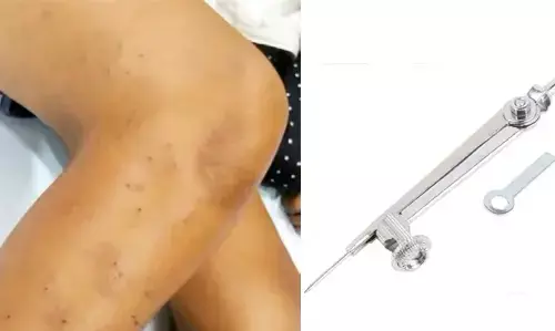 Indore News: चौथी कक्षा के छात्रों के बीच हुई लड़ाई, तीन ने मिलकर छात्र पर कंपास से 108 बार किया हमला