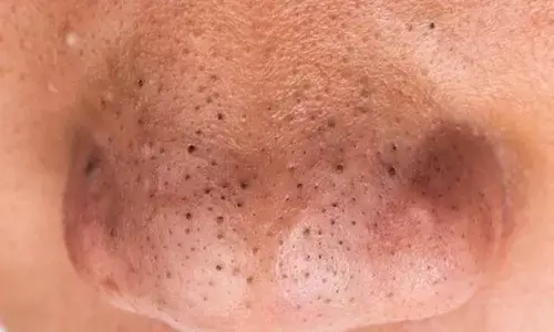 Blackheads ke Upay: ब्लैकहेड्स के कारण खो गई है चेहरे की चमक,तो जानिए कैसे हटायें ब्लैकहेड्स..