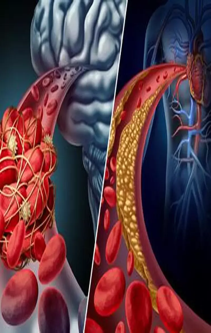 Brain Stroke-Heart Attack: जानिए ये 4 धांसू उपाय, ब्रेन स्ट्रोक और हार्ट अटैक के खतरे को कहेगी टाटा - बाय बाय...