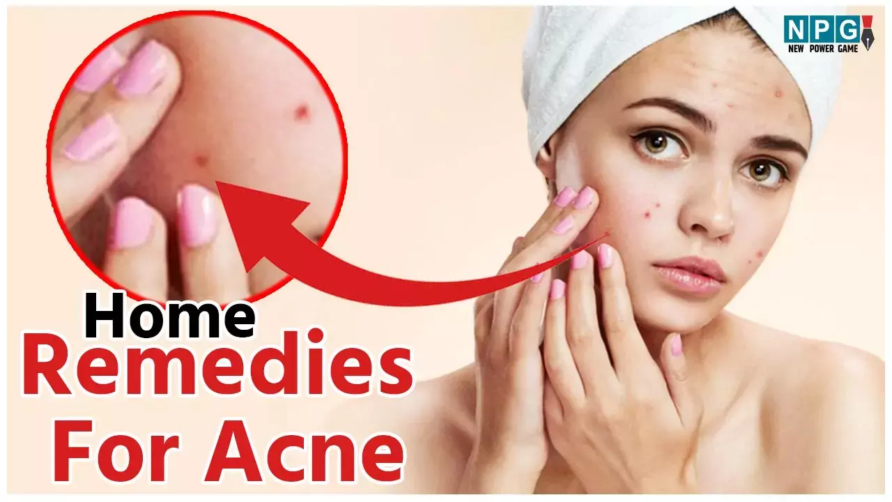 Home Remedies For Acne: वैलेंटाइंस डे से पहले चेहरे के मुंहासे होंगे दूर, रूप निखरेगा,अपनाइये ये घरेलू नुस्खे....