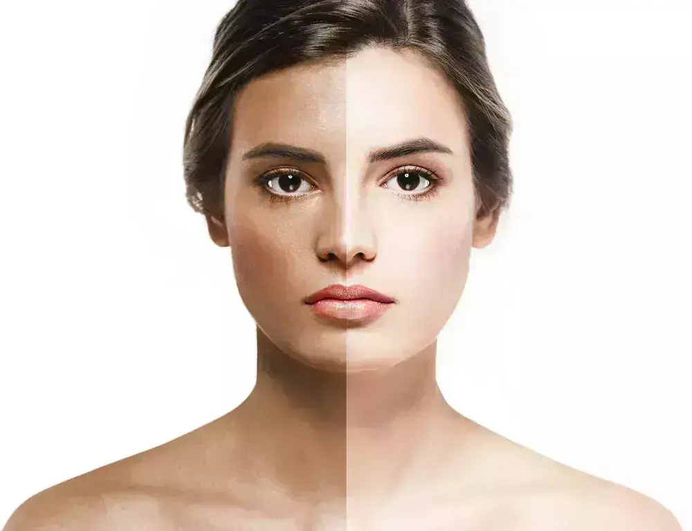 Sun tan :  घरेलू उपाय से भी कर सकते हैं सन टैन दूर