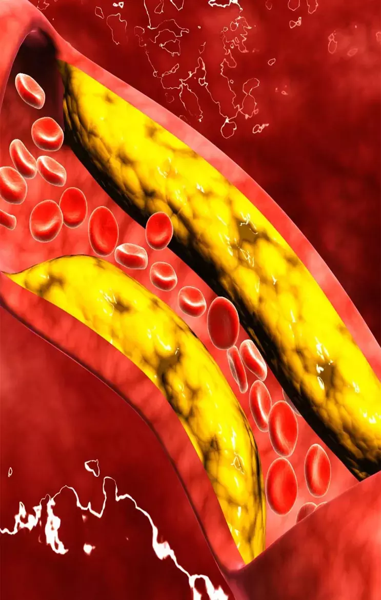 High Cholesterol Ke Karan: डीप फ्राइड आइटम्स से हैं दूर? फिर भी इन कारणों से बढ़ सकता है कोलेस्ट्रॉल...