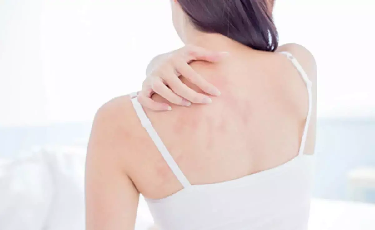 ITCHING IN SUMMER: गर्मी में खुजली आम समस्या... घरेलू चीजों से पाएं राहत