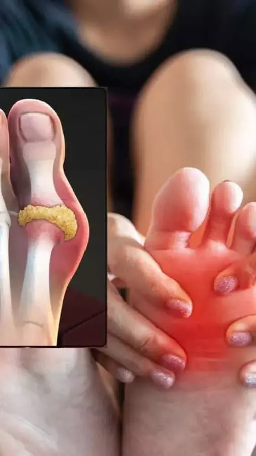 High Uric Acid: ये चीज़ें बढ़े हुए यूरिक एसिड वालों के लिए हैं जहर समान, बनाएं इनसे दूरी...