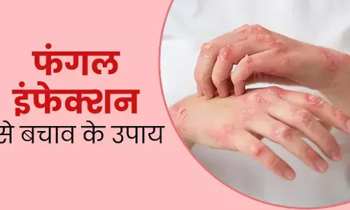 Fungal Infection: उमस के कारण बढ़ जाता है फंगल इंफेक्‍शन का खतरा, जानिए बचाव के घरेलू उपाय