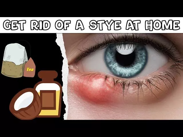Home remedies for stye : बारिश में आंखों में संक्रमण आम बात... घरेलु उपाय से बचे बिलनी या गुहेरी से Home remedies for stye : बारिश में आंखों में संक्रमण आम बात... घरेलु उपाय से बचे बिलनी या गुहेरी से