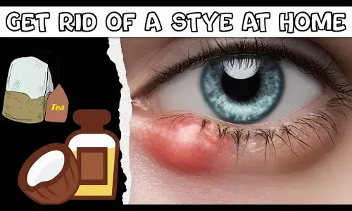 Home remedies for stye : बारिश में आंखों में संक्रमण आम बात... घरेलु उपाय से बचे बिलनी या गुहेरी से