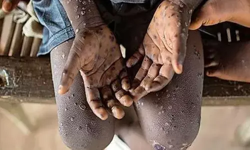 India Monkeypox Alert: दुनिया भर में फैल रहा Mpox, केंद्र ने जारी किया अलर्ट, जानिए क्या है इसके लक्षण