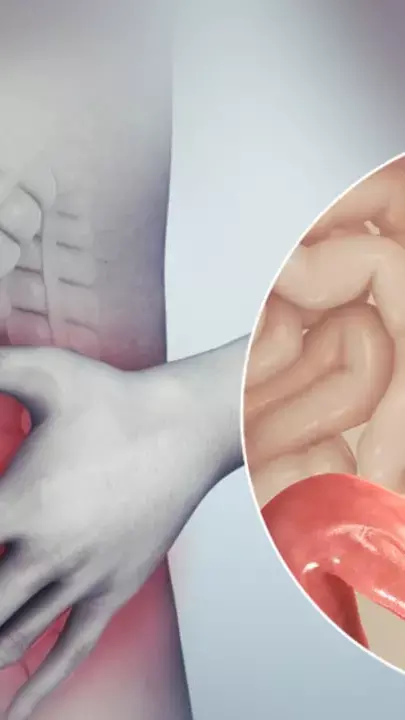 Irritable Bowel Syndrome: इरिटेबल बाउल सिंड्रोम में इन घरेलू उपायों से मिलेगी राहत...