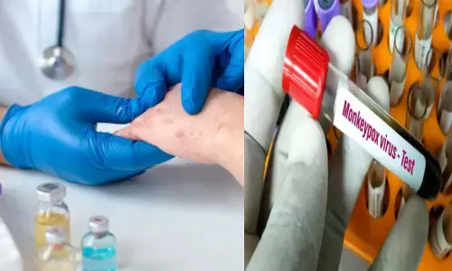CG: मंकी पॉक्स को लेकर एडवायजरी जारी, जानिए क्या है ये बीमारी और कैसे करें बचाव व रोकथाम...
