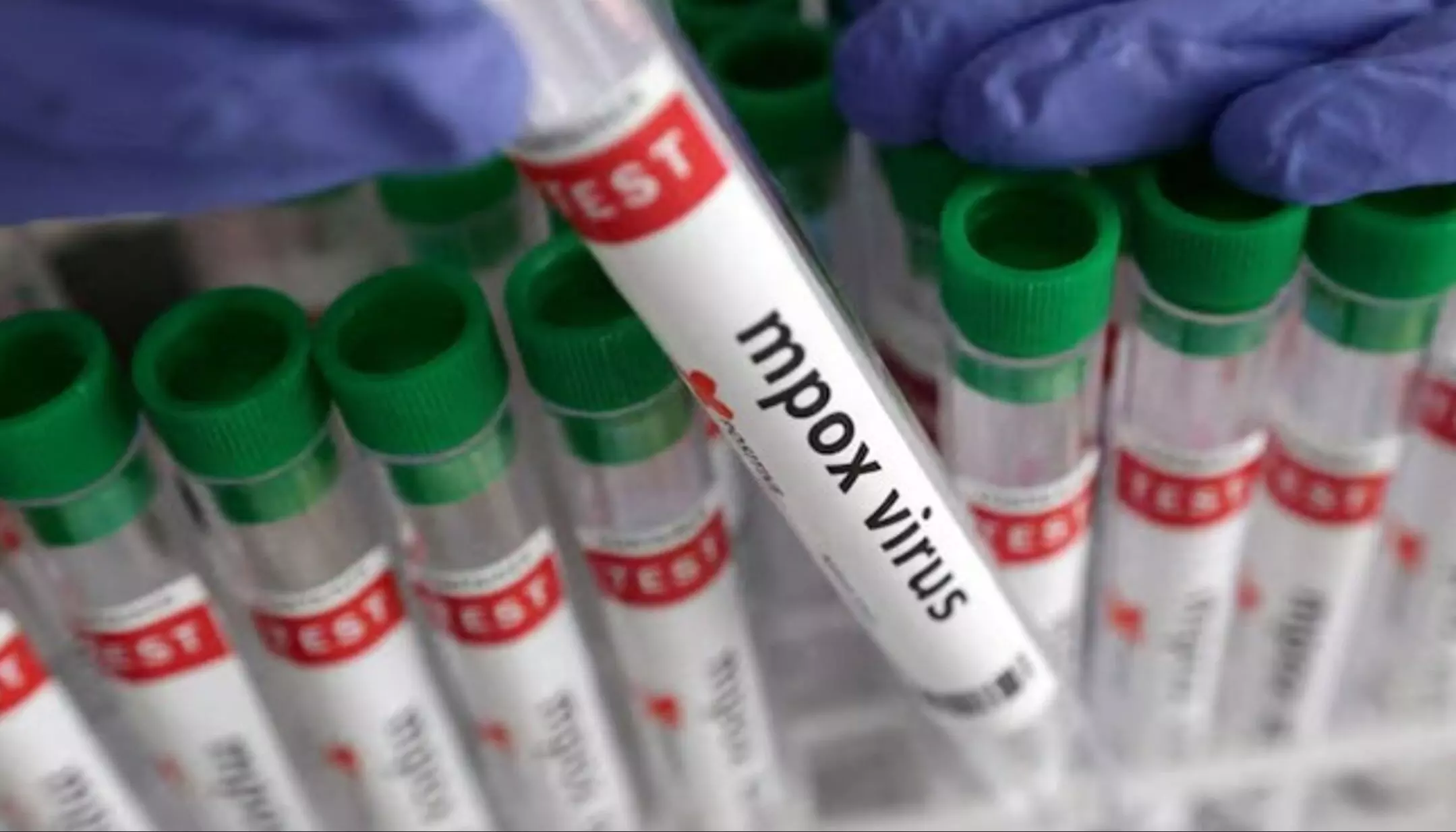 Monkeypox in India: दिल्ली में एमपॉक्स के संदिग्ध मरीज मिलने पर हड़कंप, स्वास्थ्य मंत्रालय ने जारी की एडवाइजरी