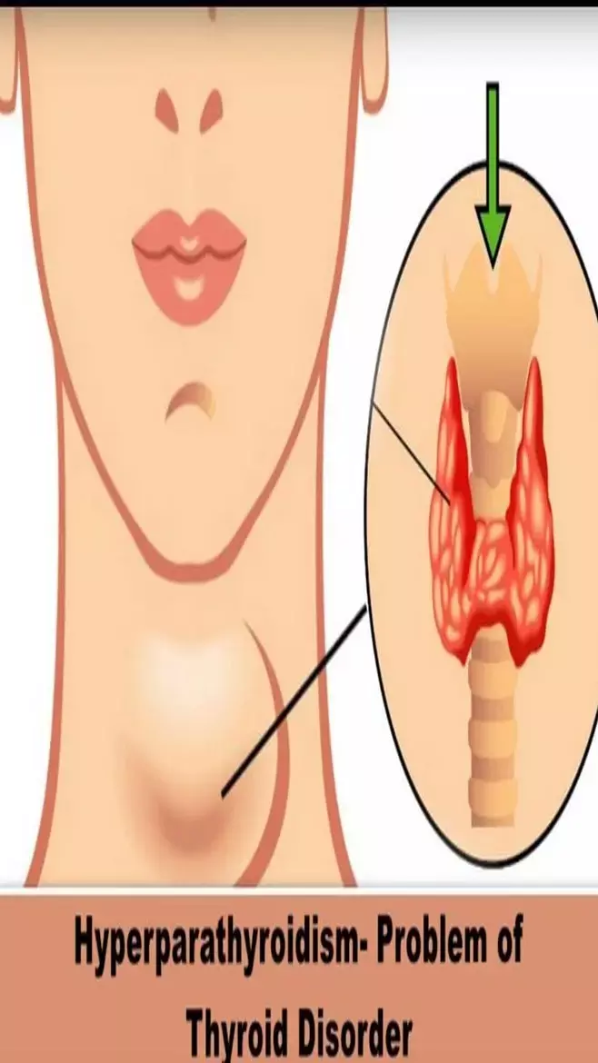 Causes Of Excessive Sweating and Home Remedies: क्या आपको भी आता है बहुत ज्यादा पसीना? ये हो सकते हैं कारण...