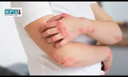 Skin Disease: सोरायसिस, त्वचा की गंभीर समस्या और इसके आधुनिक इलाज
