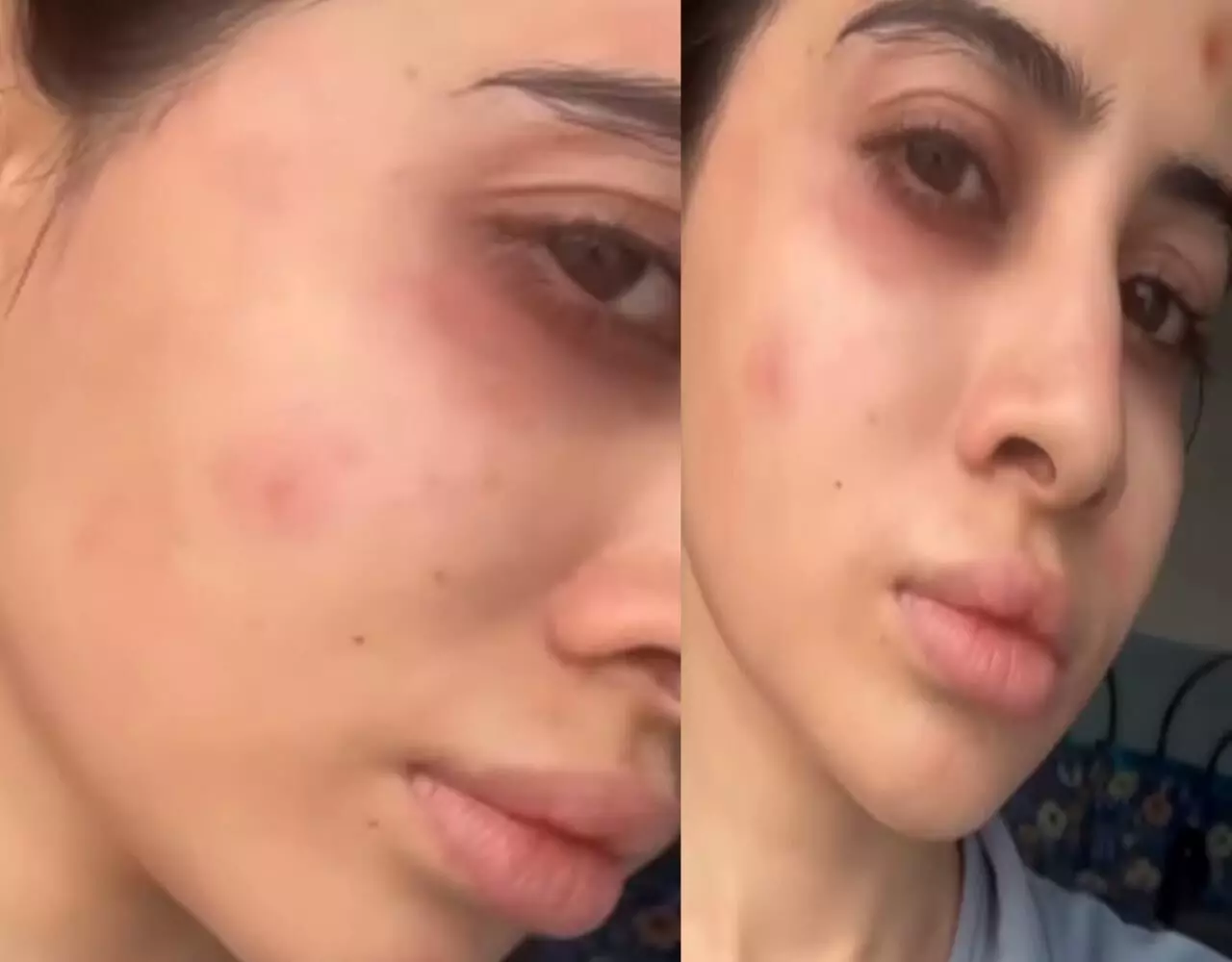 Urfi Javed News: उर्फी के साथ हुआ बड़ा हादसा: चेहरा की हुई ऐसी बुरी हालत, शक्ल पहचान पाना मुश्लिक, देखें वीडियो... Urfi Javed News: उर्फी के साथ हुआ बड़ा हादसा: चेहरा की हुई ऐसी बुरी हालत, शक्ल पहचान पाना मुश्लिक, देखें वीडियो...
