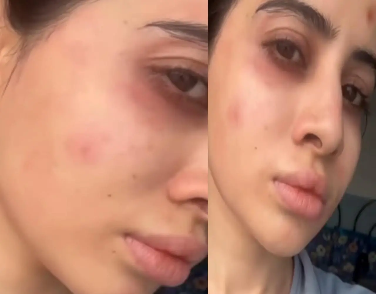 Urfi Javed News: उर्फी के साथ हुआ बड़ा हादसा: चेहरा की हुई ऐसी बुरी हालत, शक्ल पहचान पाना मुश्लिक, देखें वीडियो...