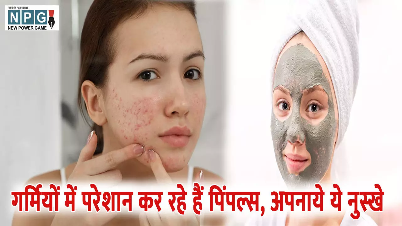 गर्मियों में हो रहे हैं पिंपल्स, छुटकारा पाने के लिए अपनाये ये असरदार घरेलू उपाय गर्मियों में हो रहे हैं पिंपल्स, छुटकारा पाने के लिए अपनाये ये असरदार घरेलू उपाय