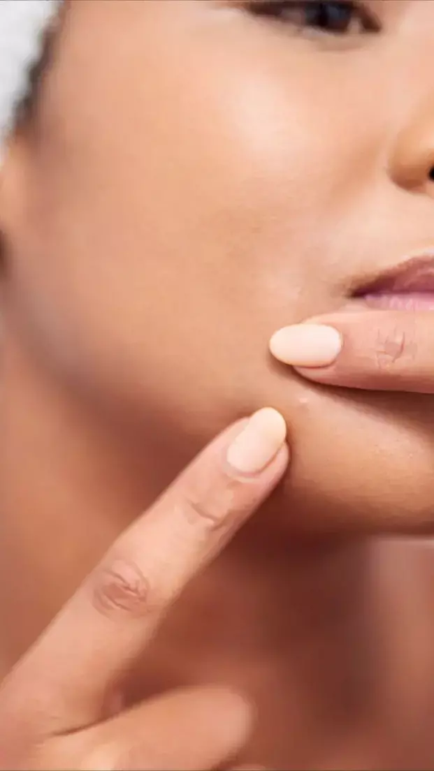 Pimple Home Remedies Hindi: पिंपल्स से निजात पाने के लिए अपनाएं ये 7 घरेलू उपाय