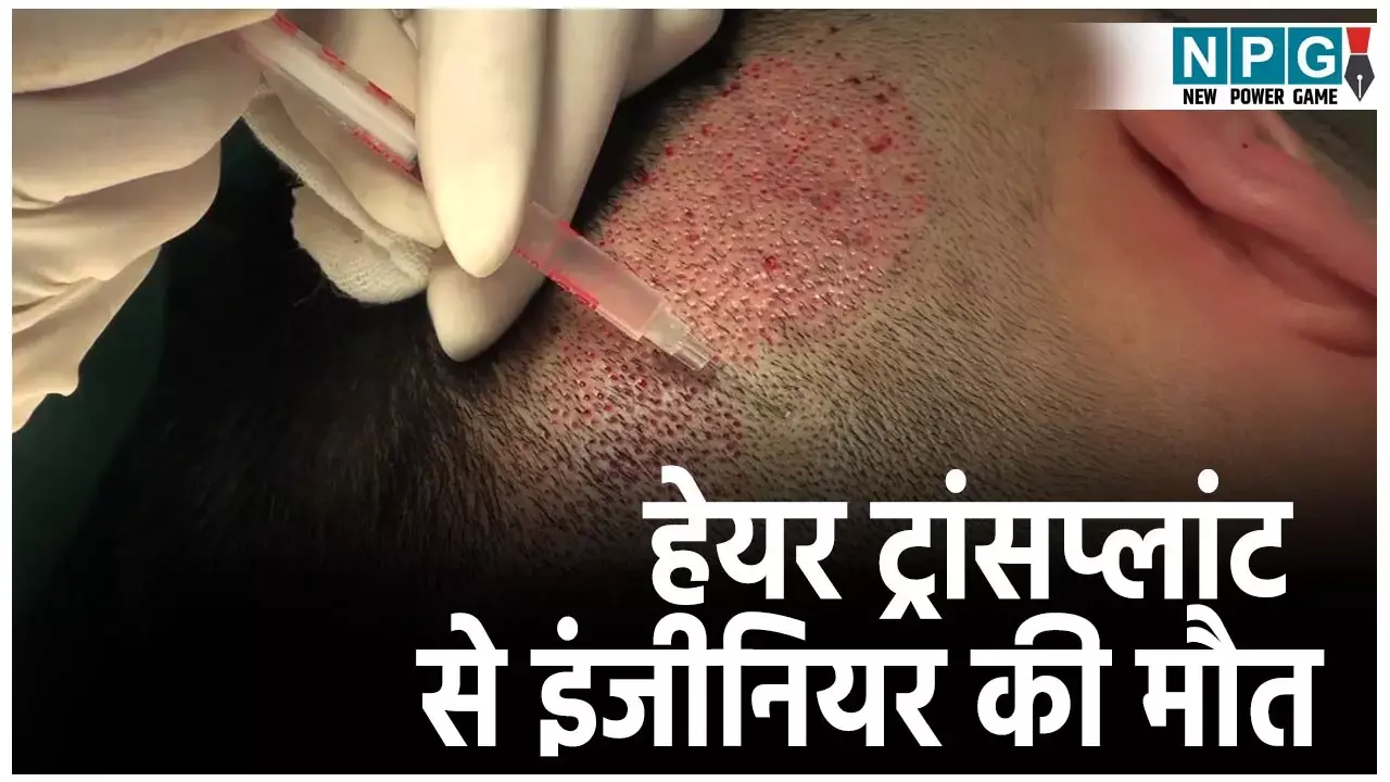 UP Hair Transplant Death Case: हेयर ट्रांसप्लांट से गई इंजीनियर की जान,