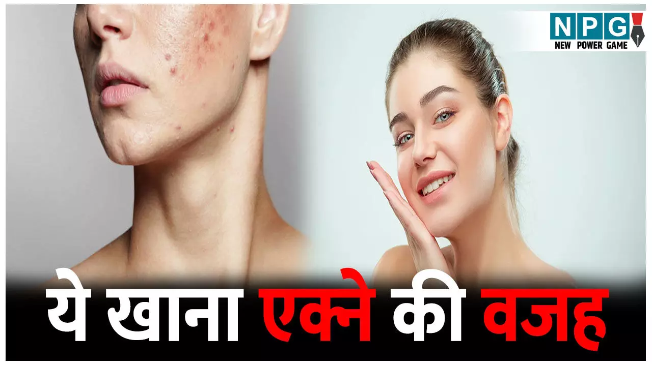 Skin Care: क्या अप भी एक्ने से हैं परेशान? आज ही बंद करें ये खाना