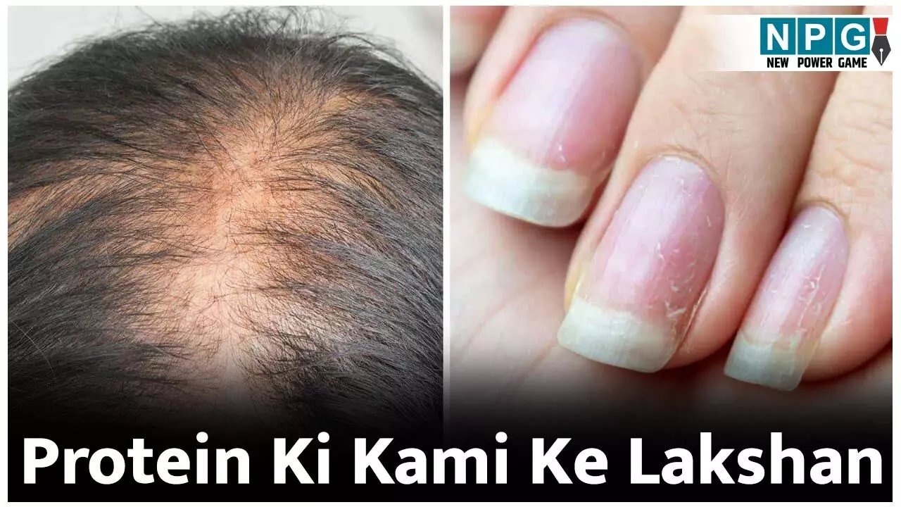 Protein Ki Kami Ke Lakshan: कहीं आपके शरीर में तो नहीं है प्रोटीन की कमी? इन 10 लक्षणों से पहचानिये...