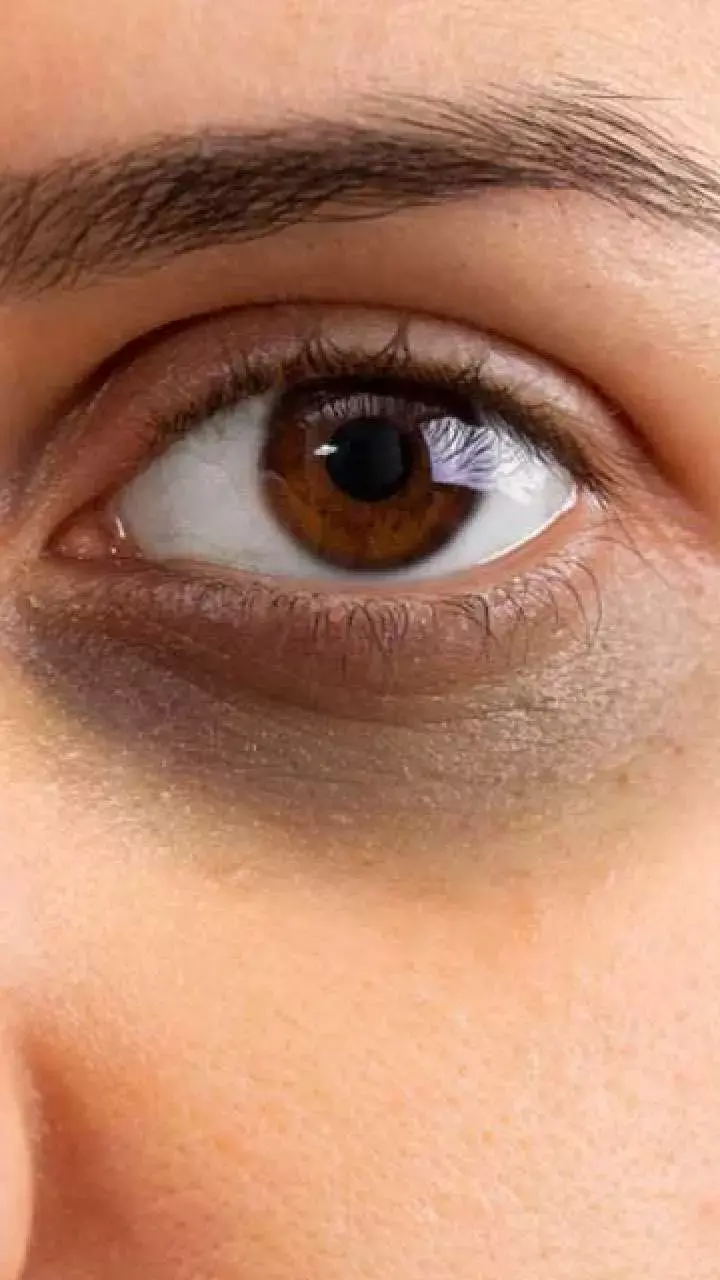 Dark Circle Kaise Hataye: डार्क सर्कल से राहत पाने के लिए, बस इस असरदार एक चीज का रक लें इस्तेमाल!