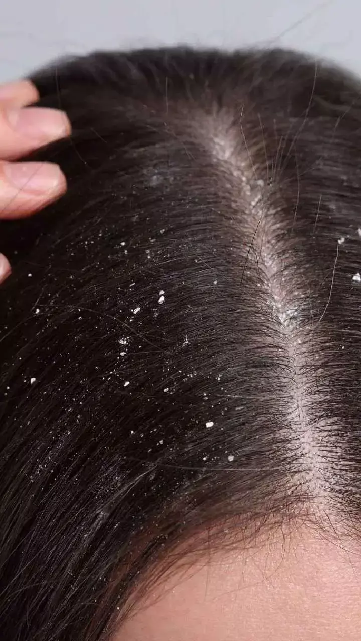 Hair Care Tips: बिना खर्चे हटाएं डैंड्रफ और खुजली, ये घरेलू नुस्खे देंगे बालों को राहत और चमक