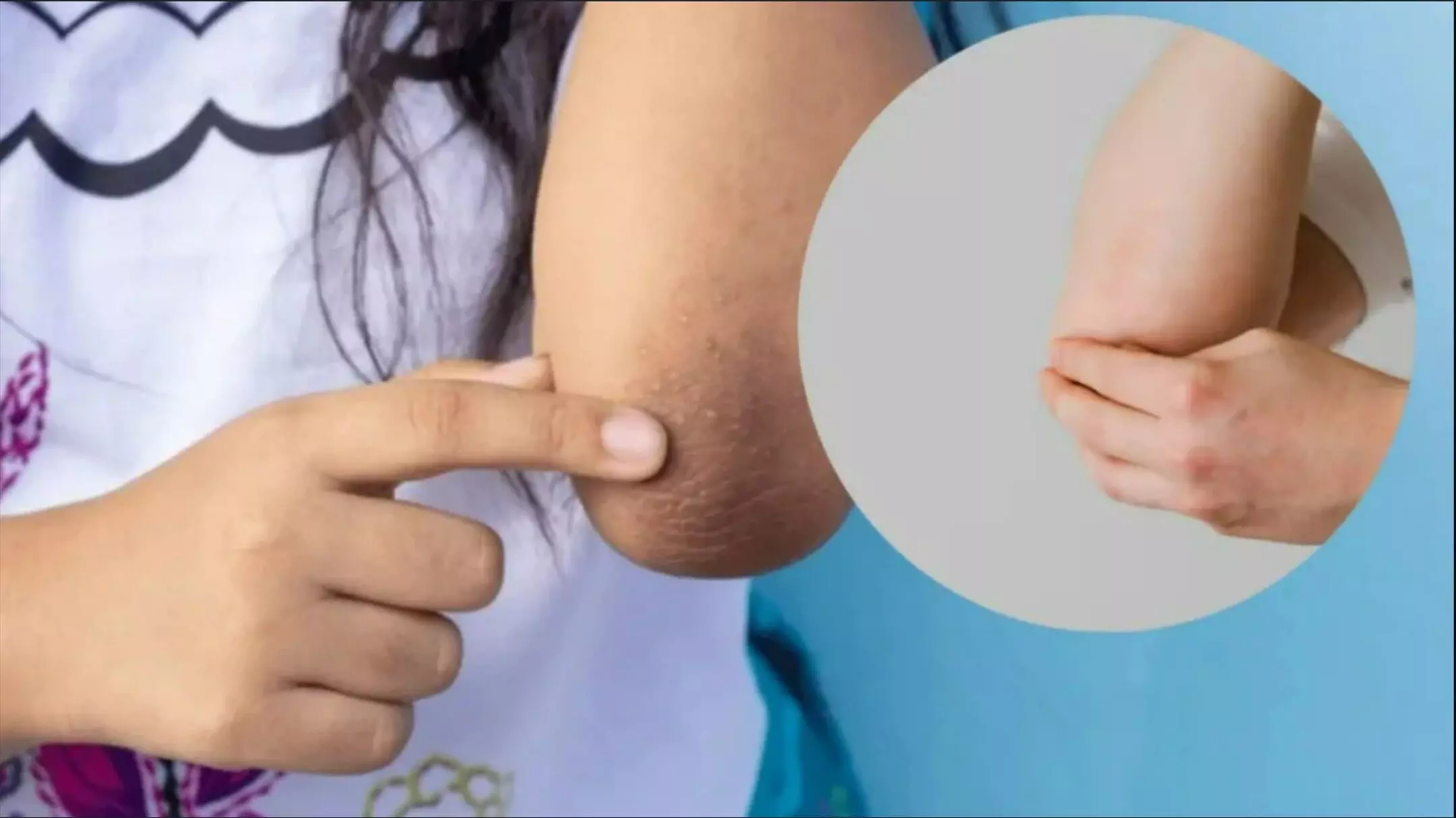 Elbow Darkness Remedies: कोहनी का कालापन मिनटों में होगा छू-मंतर! जानिए 5 असरदार घरेलू नुस्खे जो तुरंत दिखाएं असर Elbow Darkness Remedies: कोहनी का कालापन मिनटों में होगा छू-मंतर! जानिए 5 असरदार घरेलू नुस्खे जो तुरंत दिखाएं असर