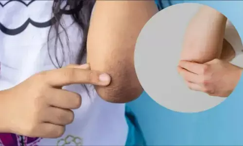 Elbow Darkness Remedies: कोहनी का कालापन मिनटों में होगा छू-मंतर! जानिए 5 असरदार घरेलू नुस्खे जो तुरंत दिखाएं असर