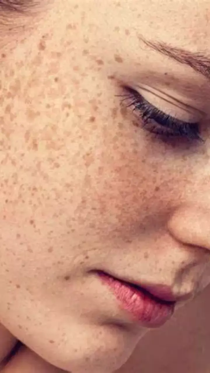 Pigmentation Kam Karne Ke Liye Kya khayain: झाइयों पर बेअसर हैं महंगी क्रीम? खाने में शामिल करें ये चीज़ें