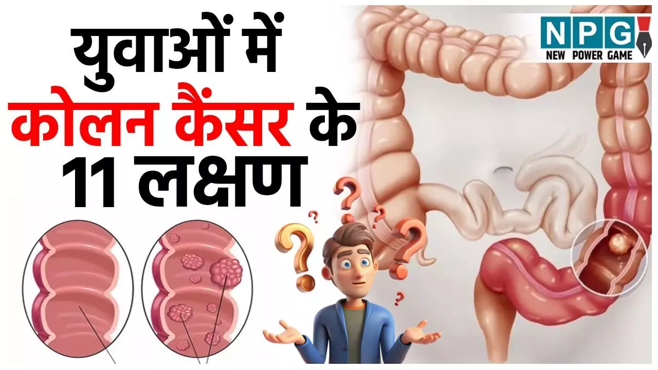 Colon Cancer Symptoms: युवाओं में बढ़ रहे कोलन कैंसर के मामले, इन 11 लक्षणों को न करें इग्नोर...