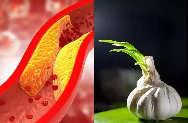 Garlic Benefits For Cholesterol : लहसुन की एक कली बचाएगी हाई कोलेस्ट्रॉल से, जानिए कैसे Garlic Benefits For Cholesterol : लहसुन की एक कली बचाएगी हाई कोलेस्ट्रॉल से, जानिए कैसे