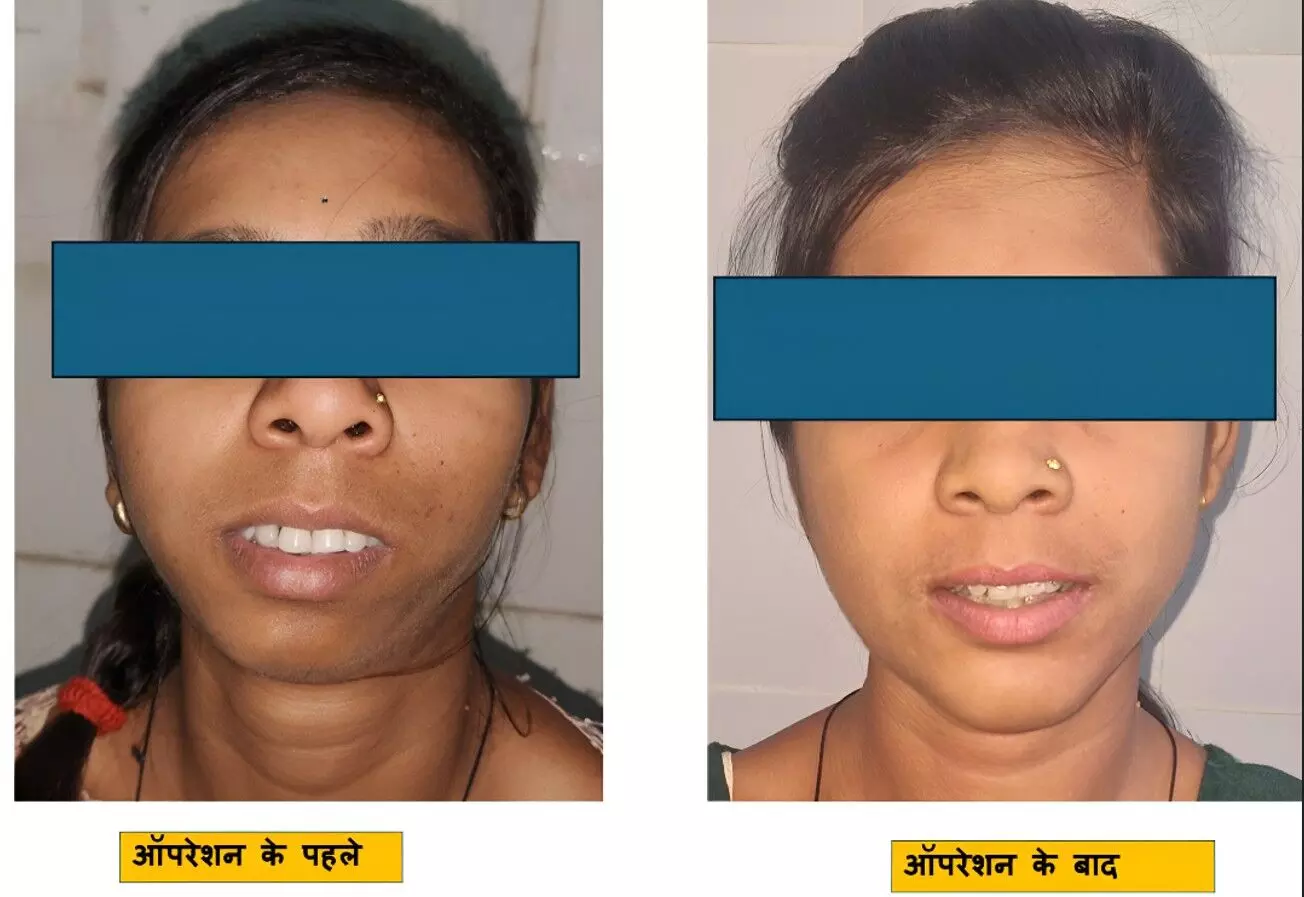 10 साल का दर्द खत्म! बिलासपुर सिम्स में पहली TJR + Orthognathic Surgery, मरीज बोली– अब मैं बिना डर घर से निकल सकती हूँ, जानिए पूरी कहानी