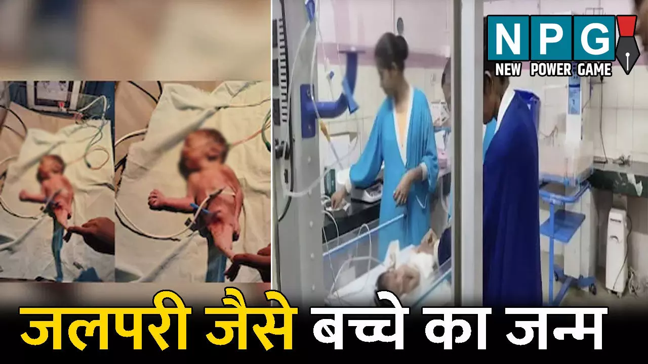 CG News:  दुर्लभ बच्चे का जन्म!  शरीर का निचला हिस्सा जलपरी जैसा, डॉक्टर भी रह गए हैरान, छत्तीसगढ़ का पहला और भारत का दूसरा केस
