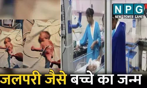 CG News:  दुर्लभ बच्चे का जन्म!  शरीर का निचला हिस्सा जलपरी जैसा, डॉक्टर भी रह गए हैरान, छत्तीसगढ़ का पहला और भारत का दूसरा केस