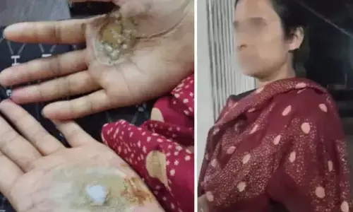 इलाज के नाम पर भारी क्रूरता: महिला के माथे पर चिपकाया सुलगता हुआ गर्म सिक्का; ढाई घंटे तक चला टॉर्चर का यह खेल, जानिए पूरा मामला