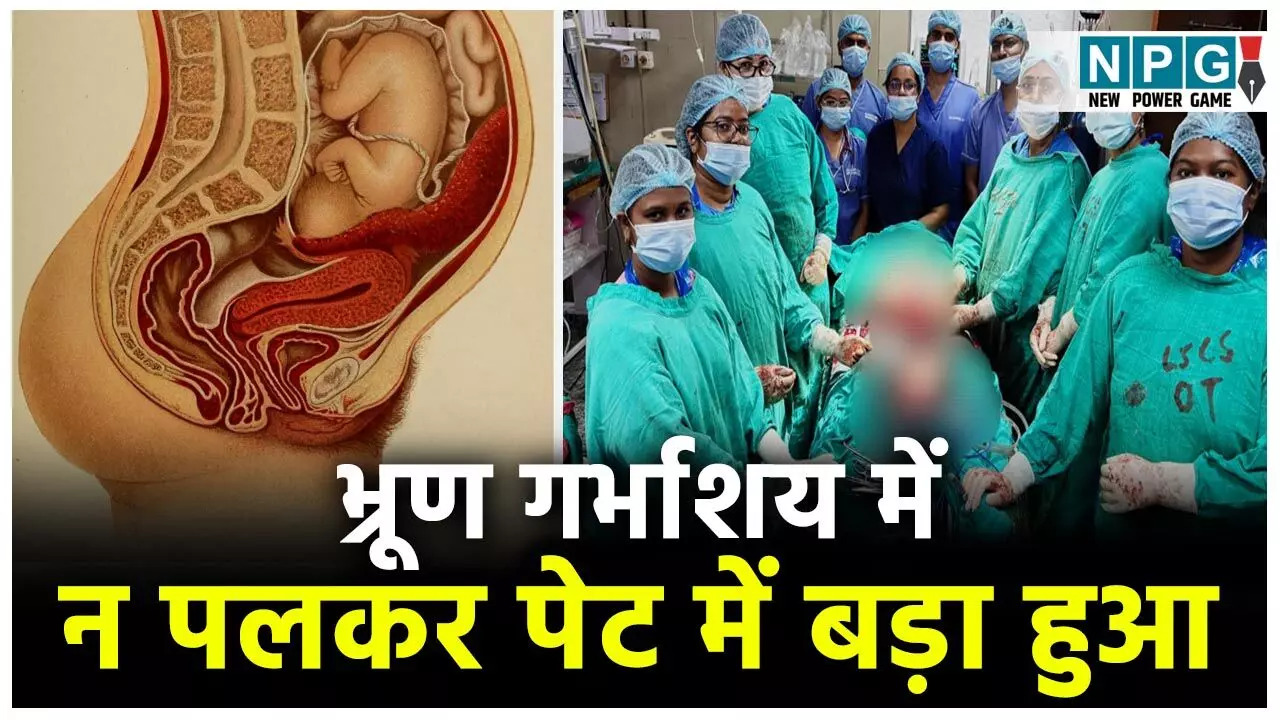 Chhattisgarh Hospital News: भ्रूण गर्भाशय में न पलकर पेट में बड़ा हुआ, आंबेडकर अस्पताल के डॉक्टरों ने किया कमाल, इमरर्जेंसी एंजियोप्लास्टी से जच्चा-बच्चा दोनों को बचा लिया...